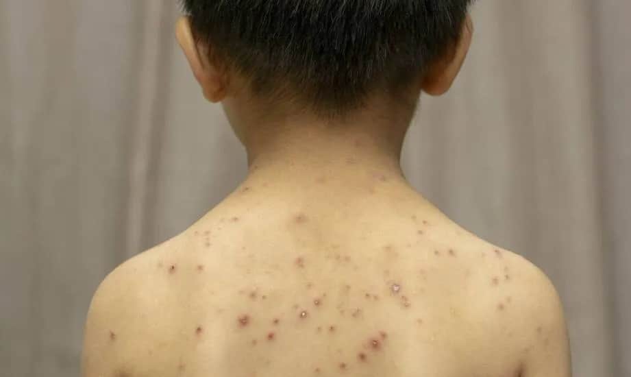 Czy dziecko ze strupami po ospie może iść do przedszkola? Ważne zasady i zalecenia